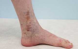 Ушиб ноги причины, симптомы, методы лечения и профилактики