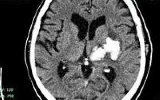 Гематома головного мозга — симптомы и лечение