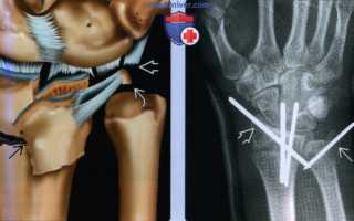 Перелом лучевой кости в нижней трети и вывих в дистальном луче-локтевом суставе (повреждение Галеацци)