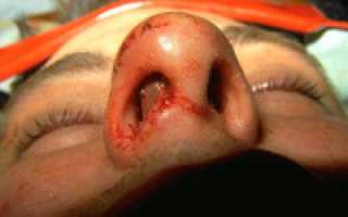 Гематома и абсцесс носовой перегородки: причины, симптомы, диагностика, лечение