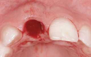 Что делать, если образовалась гематома на десне после удаления зуба?
