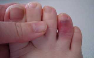 4 отличия — чтобы определить перелом у Вас или ушиб пальца ноги