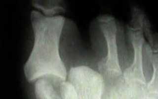 Вывих большого пальца ноги: симптомы, диагностика и лечение